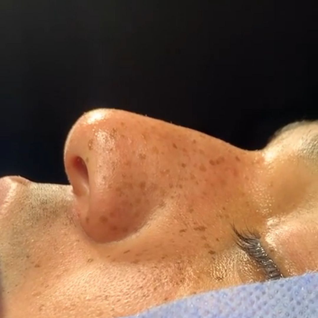 dr sedat koyunsever adana burun estetigi once sonra 2