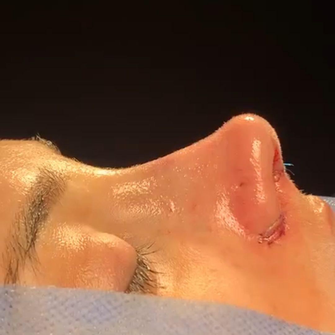 dr sedat koyunsever adana burun estetigi once sonra 5