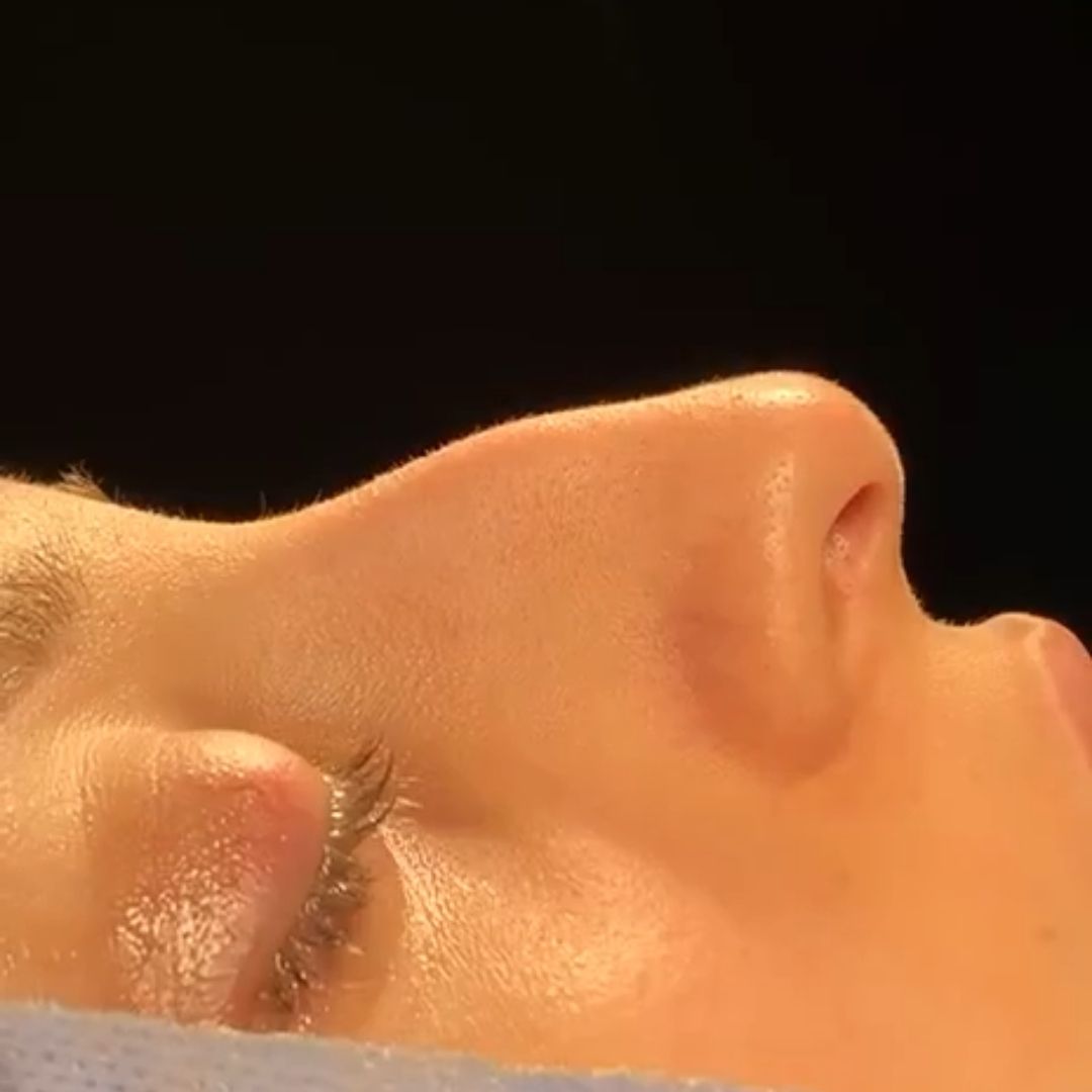 dr sedat koyunsever adana burun estetigi once sonra 6