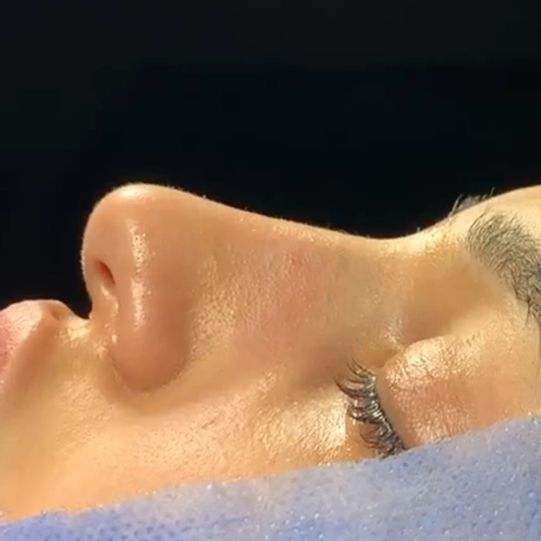 dr sedat koyunsever adana burun estetigi once sonra 8